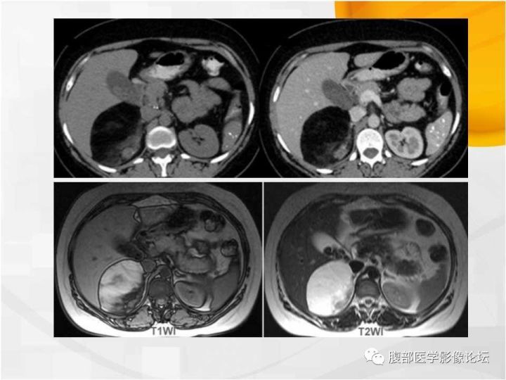 【病例】肾上腺髓质脂肪瘤1例CT及MR诊断与鉴别诊断