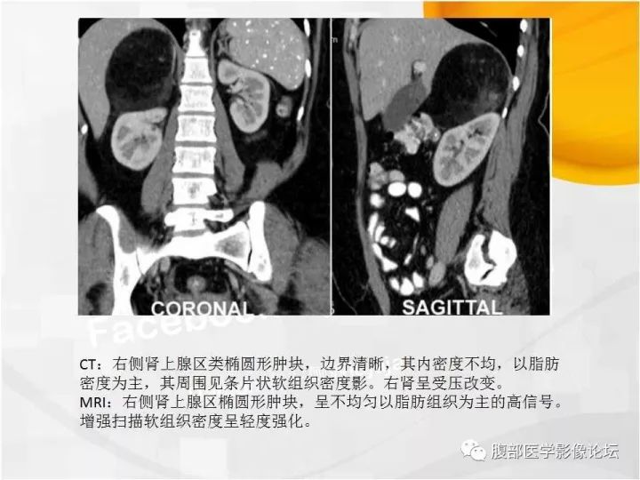 【病例】肾上腺髓质脂肪瘤1例CT及MR诊断与鉴别诊断