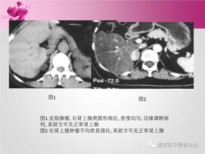 【病例】肾上腺髓质脂肪瘤1例CT及MR诊断与鉴别诊断