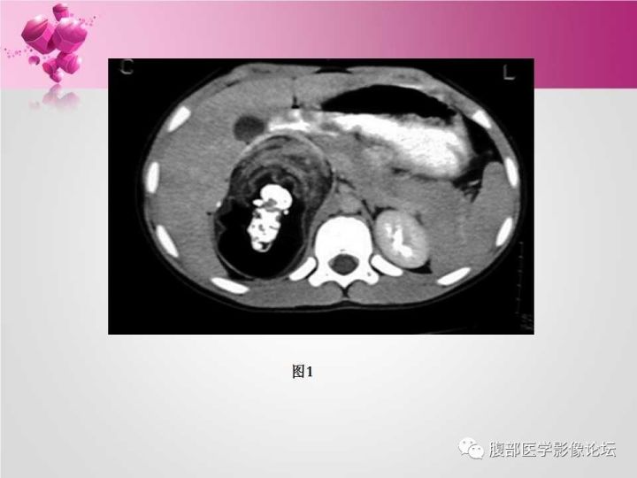 【病例】肾上腺髓质脂肪瘤1例CT及MR诊断与鉴别诊断