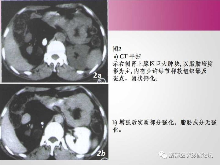 【病例】肾上腺髓质脂肪瘤1例CT及MR诊断与鉴别诊断