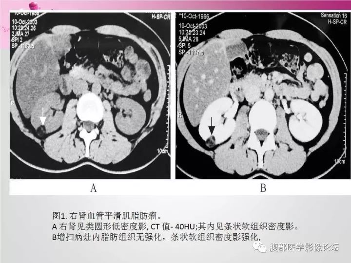 【病例】肾上腺髓质脂肪瘤1例CT及MR诊断与鉴别诊断