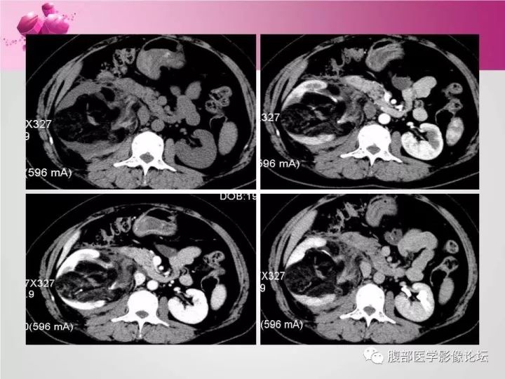 【病例】肾上腺髓质脂肪瘤1例CT及MR诊断与鉴别诊断