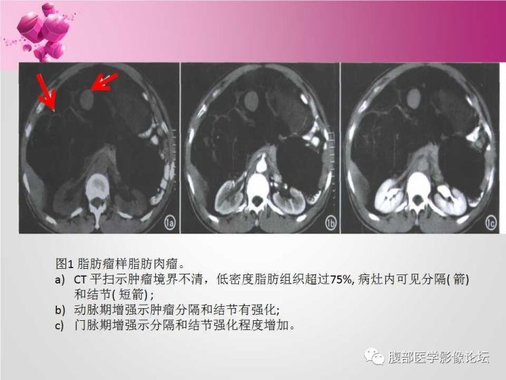 【病例】肾上腺髓质脂肪瘤1例CT及MR诊断与鉴别诊断