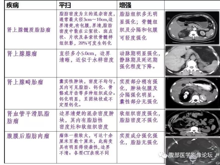【病例】肾上腺髓质脂肪瘤1例CT及MR诊断与鉴别诊断