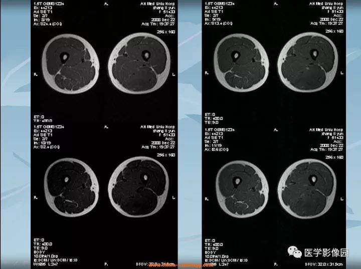 【病例】大腿纤维肉瘤1例MR