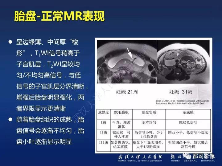 【病例】胎盘植入和前置胎盘1例MR诊断
