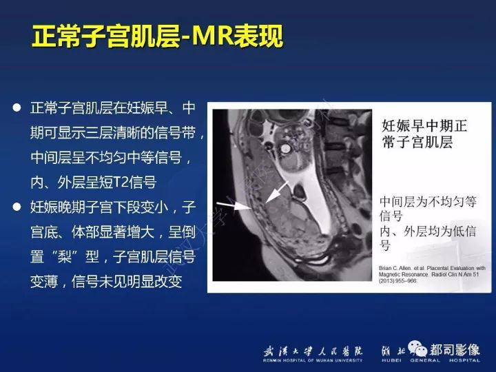 【病例】胎盘植入和前置胎盘1例MR诊断