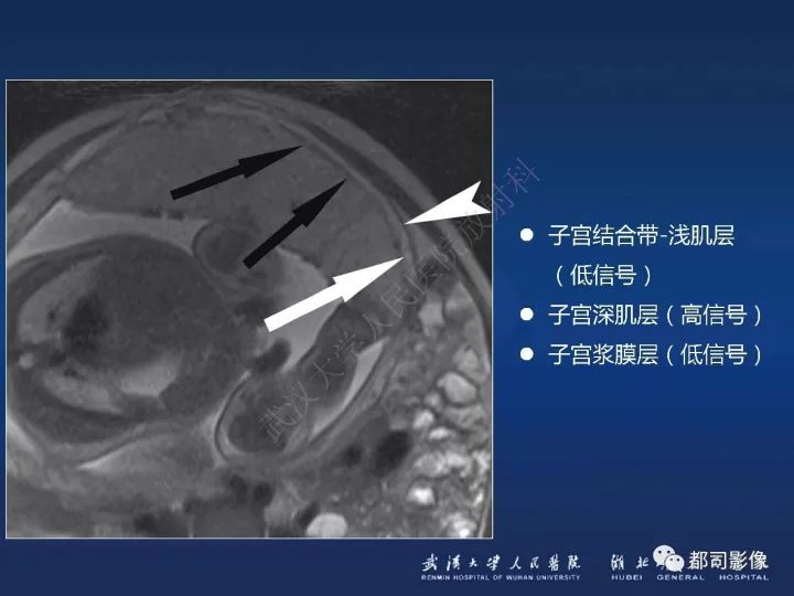 【病例】胎盘植入和前置胎盘1例MR诊断