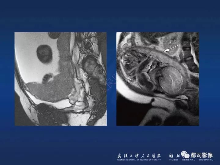 【病例】胎盘植入和前置胎盘1例MR诊断