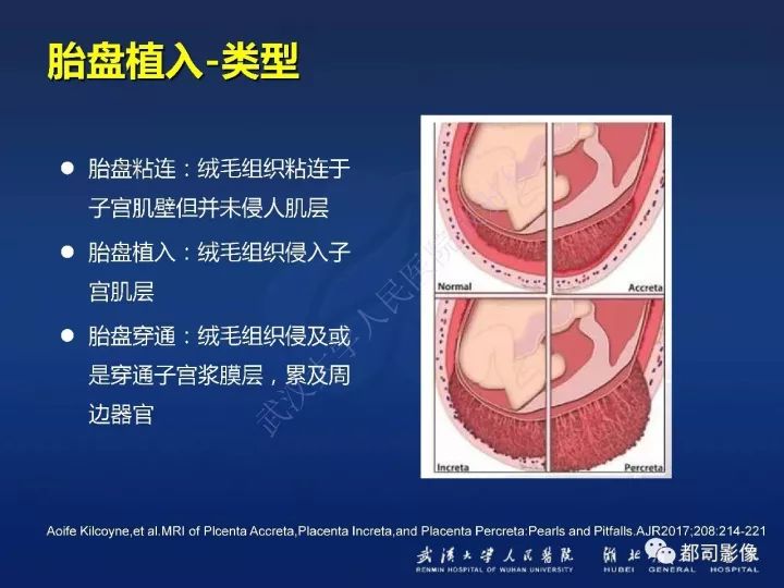 【病例】胎盘植入和前置胎盘1例MR诊断