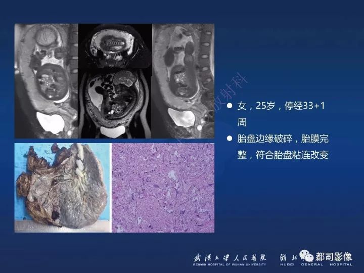 【病例】胎盘植入和前置胎盘1例MR诊断