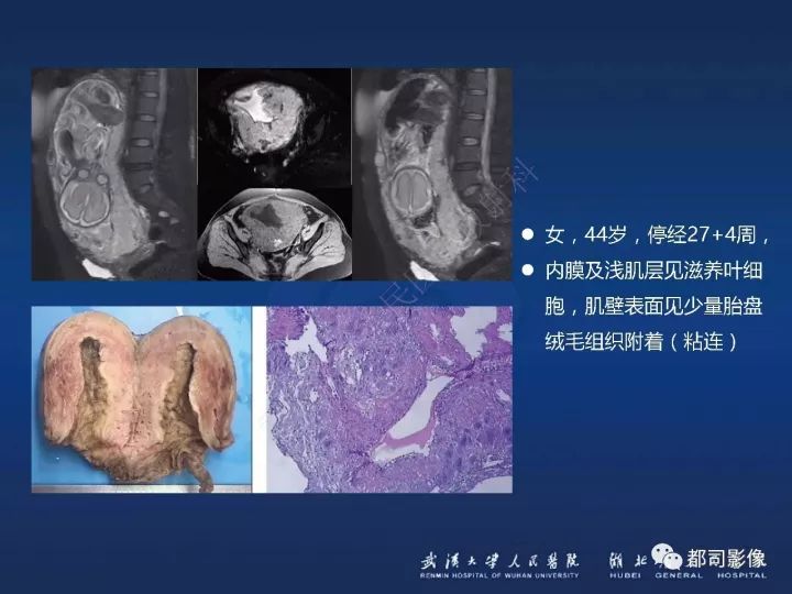 【病例】胎盘植入和前置胎盘1例MR诊断
