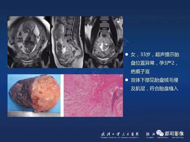 【病例】胎盘植入和前置胎盘1例MR诊断