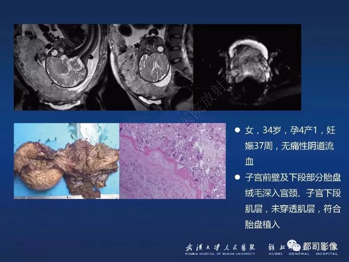 【病例】胎盘植入和前置胎盘1例MR诊断