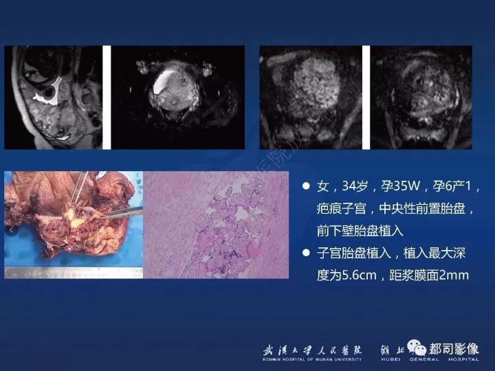 【病例】胎盘植入和前置胎盘1例MR诊断