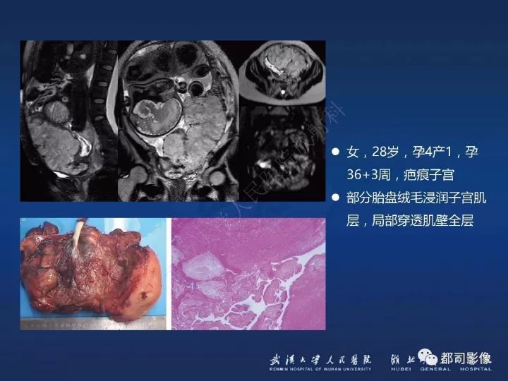 【病例】胎盘植入和前置胎盘1例MR诊断