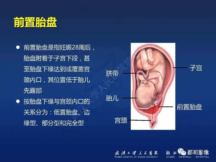 【病例】胎盘植入和前置胎盘1例MR诊断