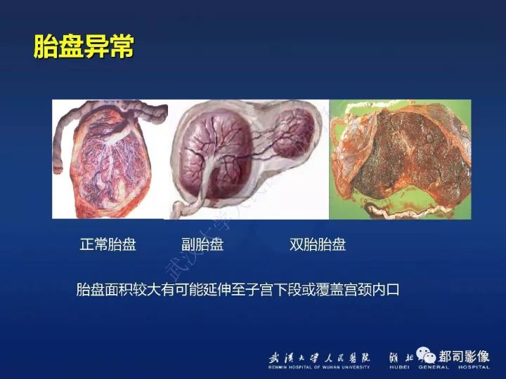 【病例】胎盘植入和前置胎盘1例MR诊断