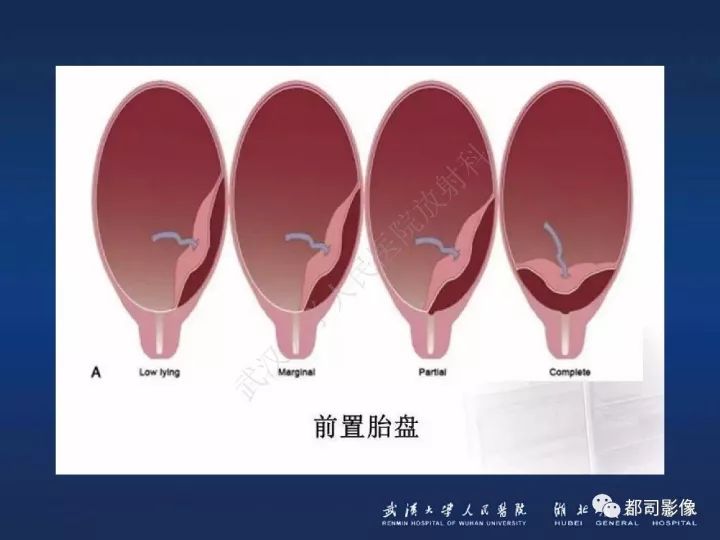 【病例】胎盘植入和前置胎盘1例MR诊断