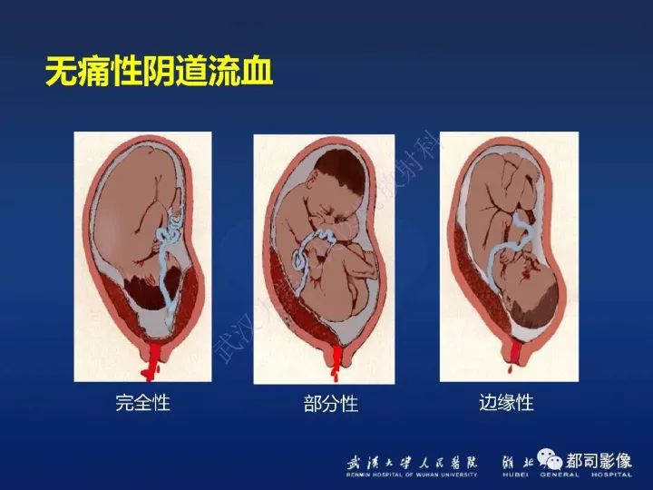 【病例】胎盘植入和前置胎盘1例MR诊断