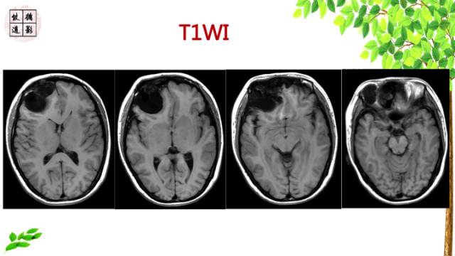 【病例】额骨骨纤维结构不良1例CT及MR
