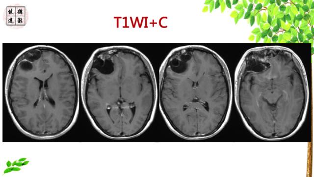 【病例】额骨骨纤维结构不良1例CT及MR