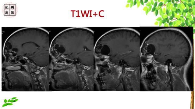 【病例】额骨骨纤维结构不良1例CT及MR