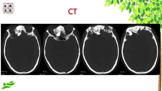 【病例】额骨骨纤维结构不良1例CT及MR