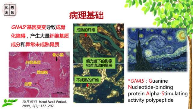 【病例】额骨骨纤维结构不良1例CT及MR