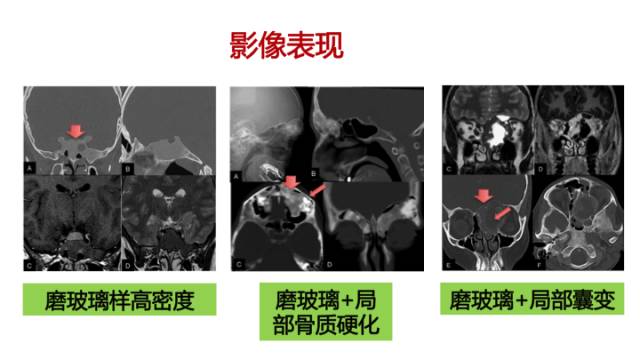 【病例】额骨骨纤维结构不良1例CT及MR