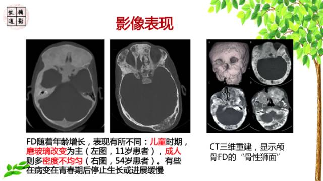 【病例】额骨骨纤维结构不良1例CT及MR