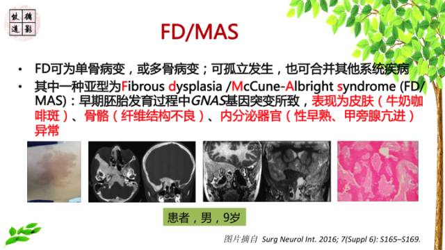 【病例】额骨骨纤维结构不良1例CT及MR