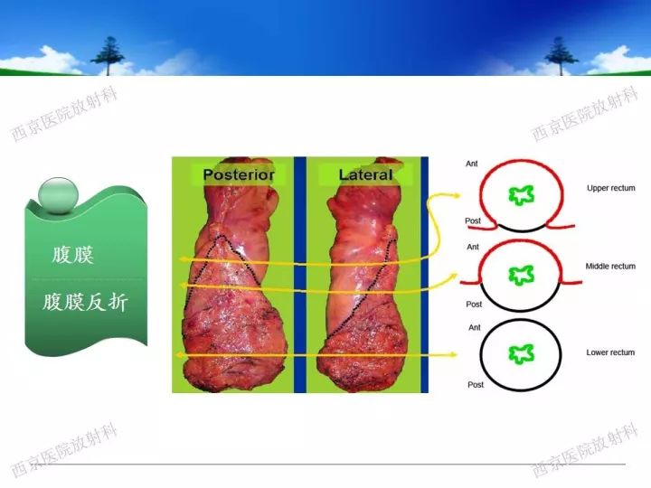 【PPT】直肠癌MRI诊断
