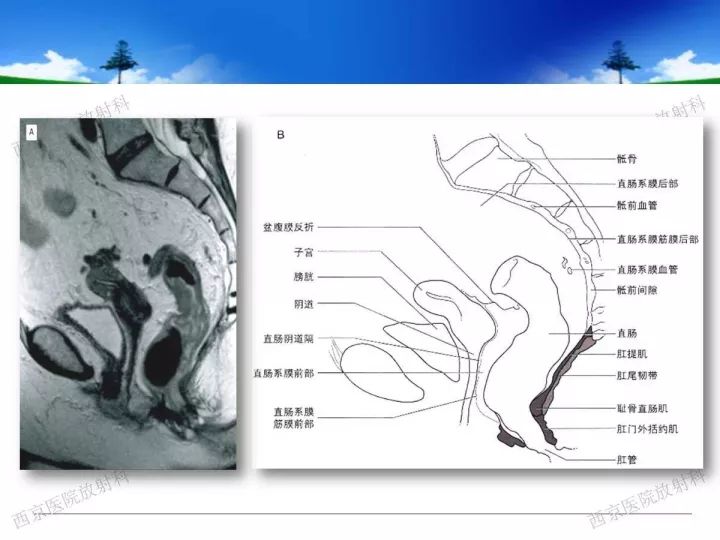 【PPT】直肠癌MRI诊断