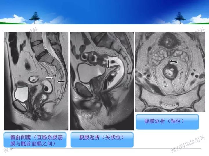 【PPT】直肠癌MRI诊断