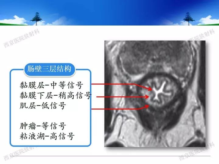 【PPT】直肠癌MRI诊断
