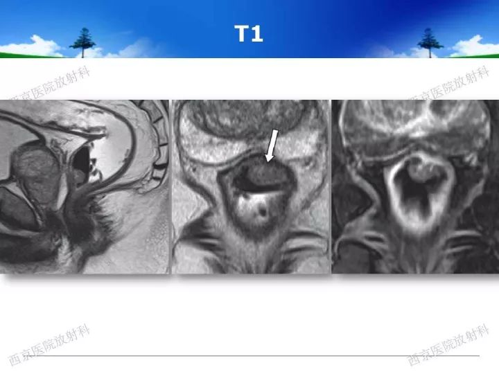 【PPT】直肠癌MRI诊断