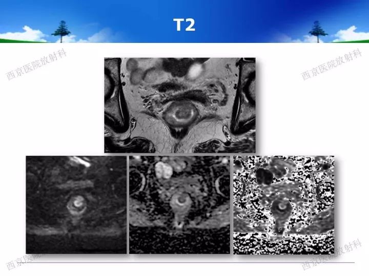 【PPT】直肠癌MRI诊断