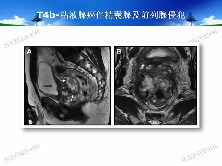 【PPT】直肠癌MRI诊断