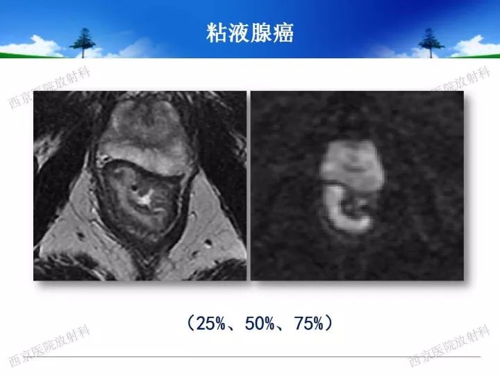 【PPT】直肠癌MRI诊断
