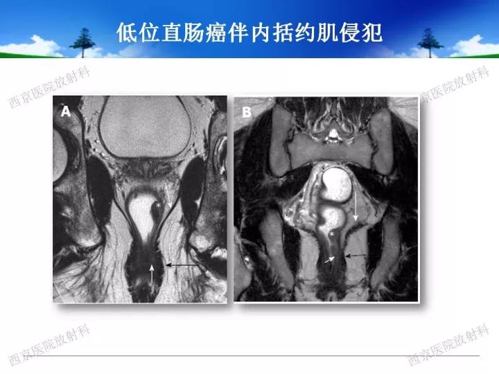 【PPT】直肠癌MRI诊断