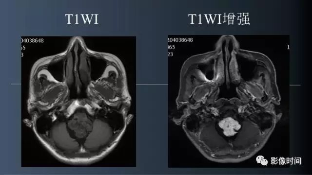 【病例】脑干实性血管母细胞瘤1例MR
