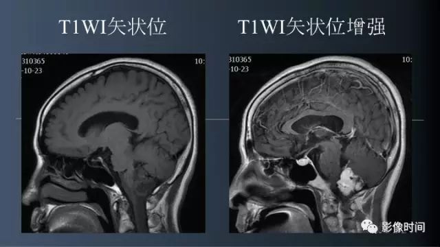 【病例】脑干实性血管母细胞瘤1例MR