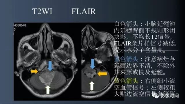 【病例】脑干实性血管母细胞瘤1例MR