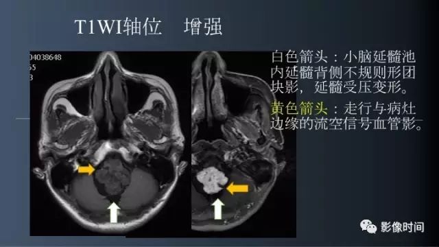 【病例】脑干实性血管母细胞瘤1例MR