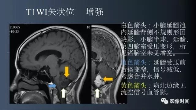 【病例】脑干实性血管母细胞瘤1例MR