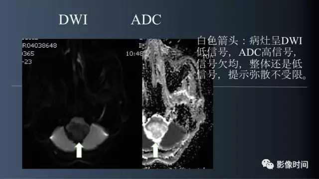 【病例】脑干实性血管母细胞瘤1例MR
