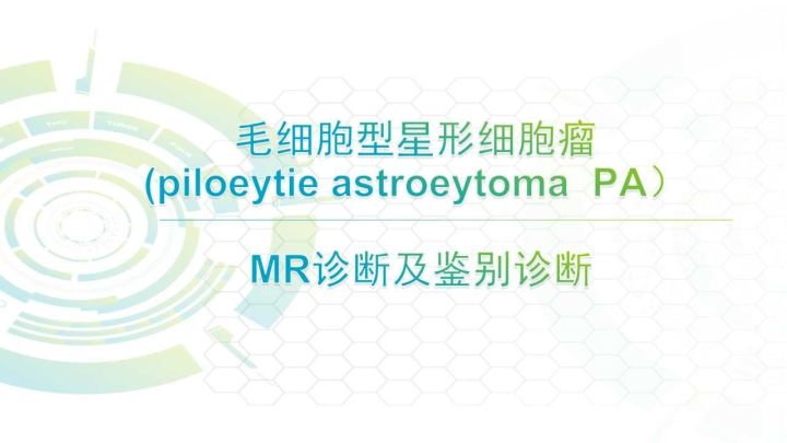 【PPT】毛细胞型星形细胞瘤MR诊断及鉴别诊断