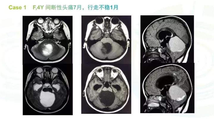 【PPT】毛细胞型星形细胞瘤MR诊断及鉴别诊断